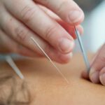 Close-up of a person receiving acupuncture, with several fine needles gently inserted into the skin by a practitioner’s hands. Photo by Katherine Hanlon on Unsplash