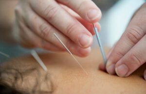 The Benefits of Acupuncture
