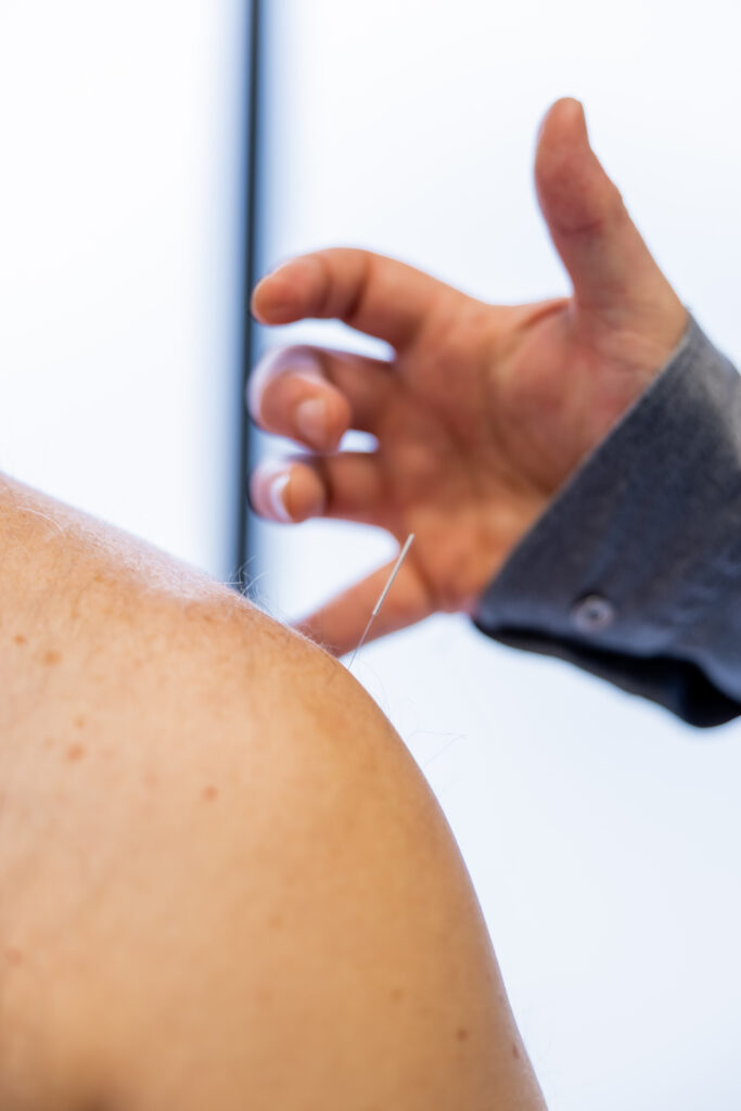 Close-up of an acupuncture needle being placed into a patient's shoulder, with the practitioner's hand guiding the needle.