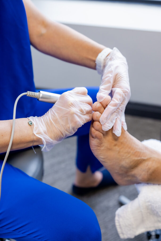Detailed close-up of Mirka Grell-Willins treating a patient's toes, focusing on precise instrument work during podiatric care.